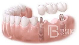 75歲老人適不適合做種植牙？北京圣貝口腔怎么樣？