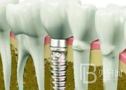 廣州固美口腔怎么樣？廣州固美口腔種植牙一顆多少錢