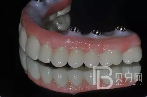 全口種植牙的利與弊都有哪些？北京拜博口腔正規(guī)嗎？