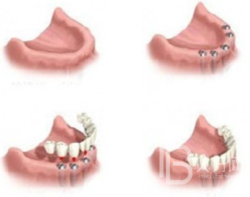 即拔即種植牙的條件？北京壹加壹口腔怎么樣？