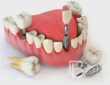 廣州好佰年口腔怎么樣？廣州好佰年口腔口碑好不好？廣州好佰年口腔種植牙價格