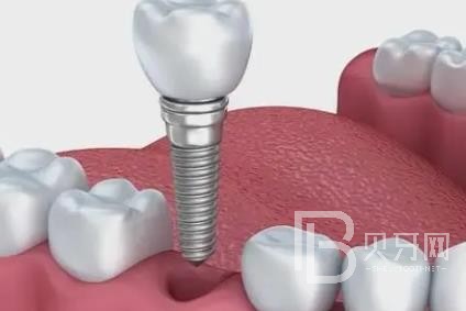 廣州愛威白口腔怎么樣？廣州愛威白口腔口碑好不好？廣州愛威白口腔種植牙價(jià)格