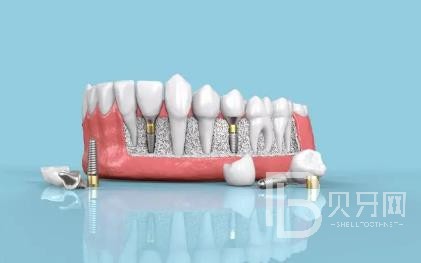 廣州六月微笑口腔怎么樣？廣州六月微笑口腔口碑好不好？廣州六月微笑口腔種植牙價(jià)格