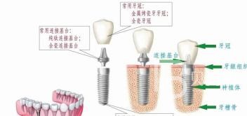 70歲的老人骨量不足還能做種植牙嗎？北京海德堡口腔怎么樣？