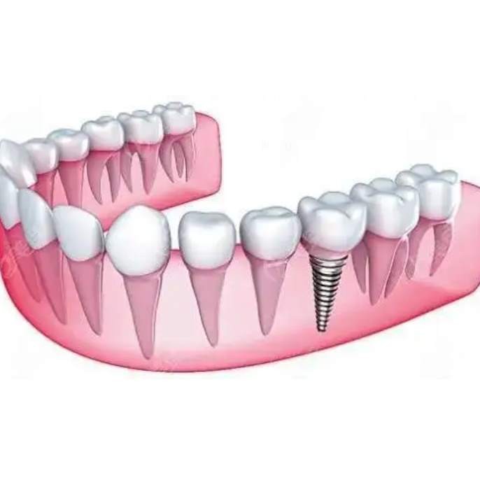 杭州種植一顆假牙多少錢！杭州聞喜淇杰口腔醫(yī)院(余杭古墩路口腔診所)種植牙價格表搶先看，國產(chǎn)拜阿蒙種植牙：2371元起/顆！