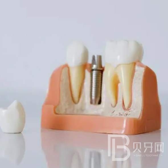 杭州種植一顆假牙多少錢！桐廬付現(xiàn)生口腔診所種植牙醫(yī)院排名TOP1，瑞典諾貝爾種植牙：5417元起/顆！