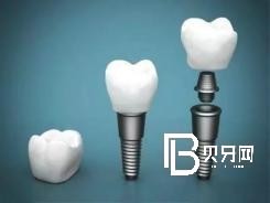 北京種植牙齒價(jià)格多少？含北京種植牙價(jià)格表！