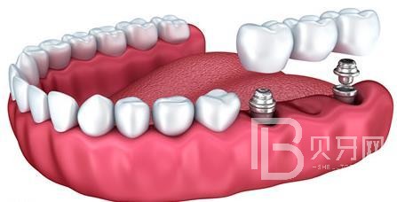 什么是半口種植牙？東莞國貿(mào)口腔來回答