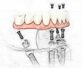 東莞好佰年口腔all on-4種植牙怎么樣？
