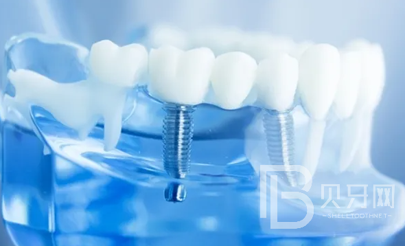 東莞牙博士口腔可以做種植牙嗎？