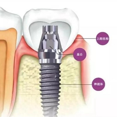 貴陽牙齦萎縮恢復(fù)種牙好的醫(yī)院是哪家？云巖美爾迪口腔診所口碑實(shí)力頂呱呱！