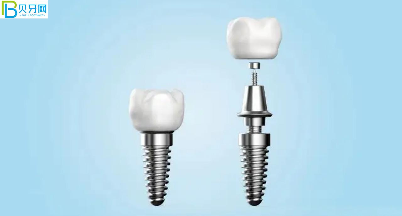 裝假牙怎么能少的了唯美口腔,聽(tīng)說(shuō)鑲牙3500元起?